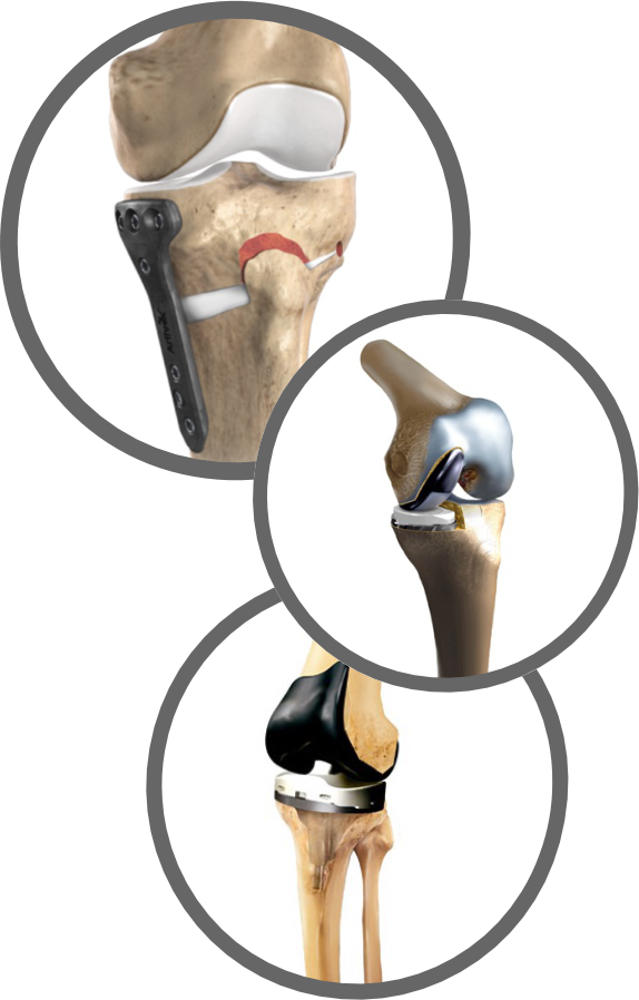 Arthrose: Korrekturosteotomie (Achsenkorrektur), Schlittenprothese, Oberflächenersatz Arthrose: Korrekturosteotomie (Achsenkorrektur), Schlittenprothese, Oberflächenersatz