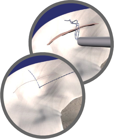 Meniskusnaht Meniskusnaht