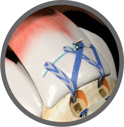 Rotatorenmanschette Rotatorenmanschette