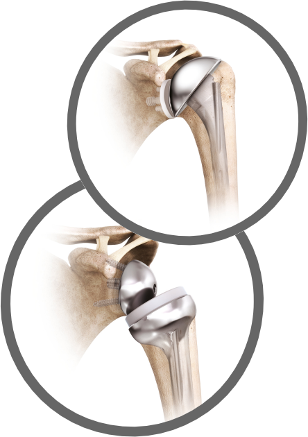 Schulterluxation Schulterluxation